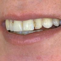 Composite Bonding - Smile 10 before